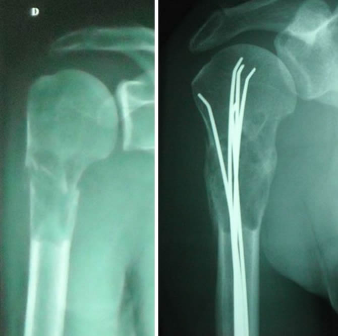 pathological fracture