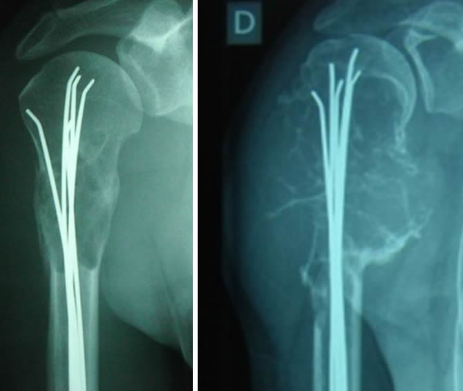 fracture healed