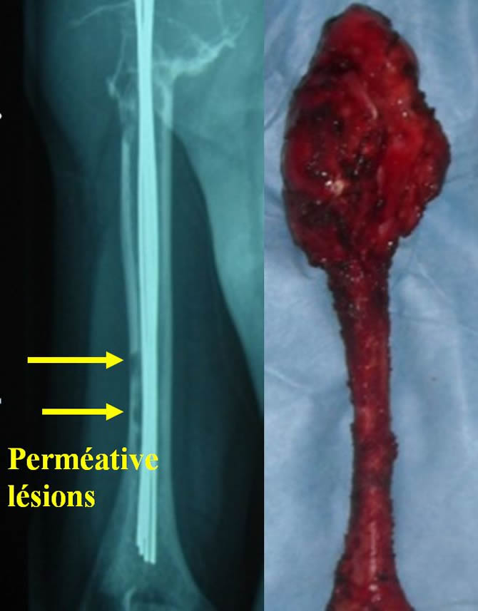 telangectasic osteosarcoma