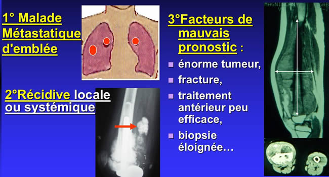 méthotrexate