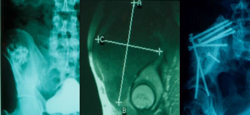 resections