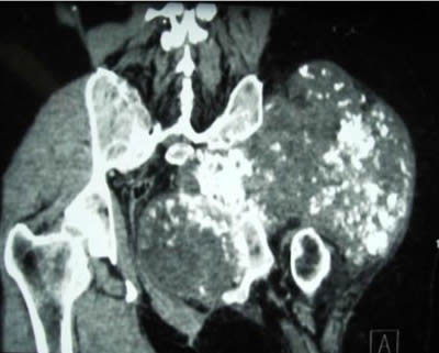 Location on iliac bone