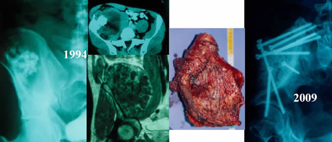 chondrosarcoma 