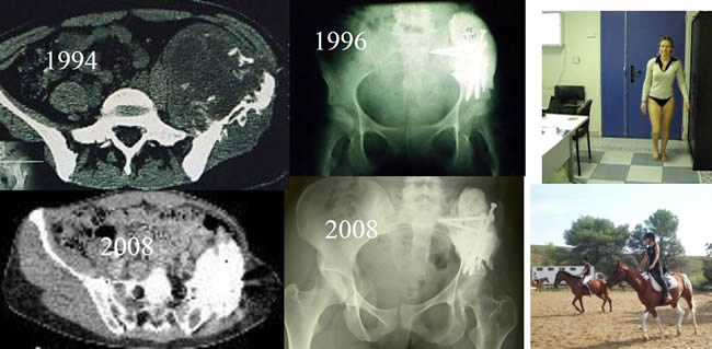 chondrosarcoma 