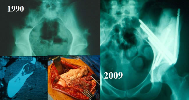 chondrosarcoma 