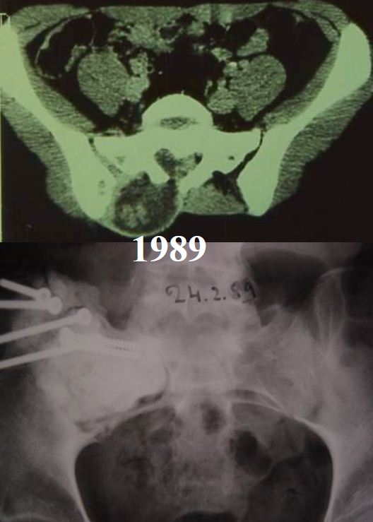 high grade tumours