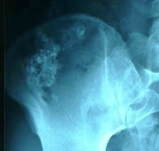 bone technetium scan