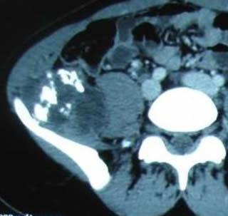 bone technetium scan