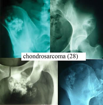 chondrosarcoma