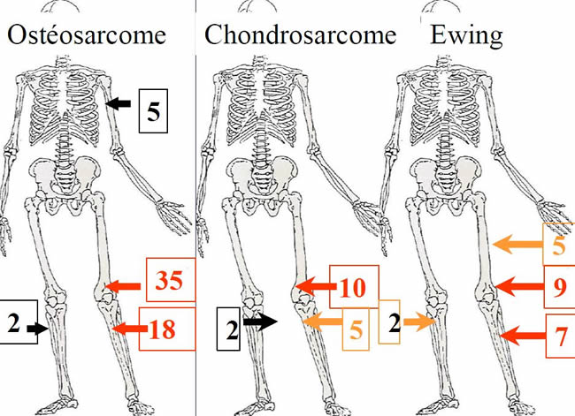 tumeurs osseuses malignes