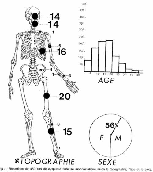 Dysplasie fibreuse monoostotique