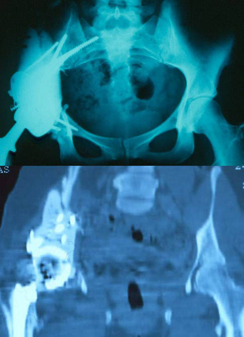 resection for EwinFonction