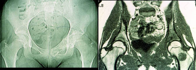 MRI and regional metastases