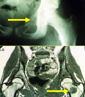 Sarcome d'Ewing iliaque
