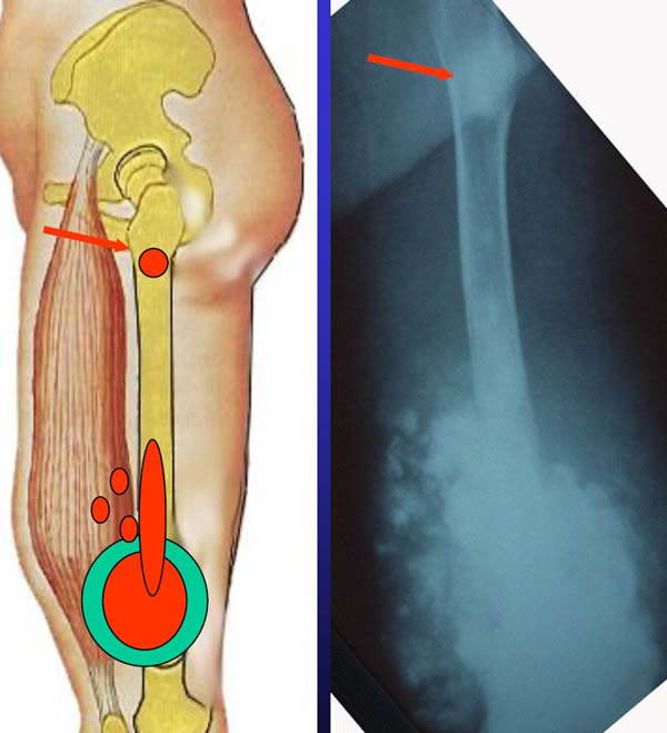 skip metastases