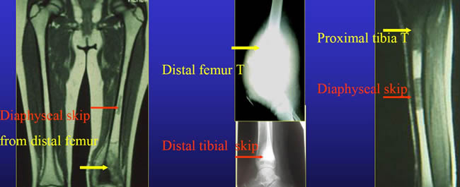 Skip in osteosarcoma