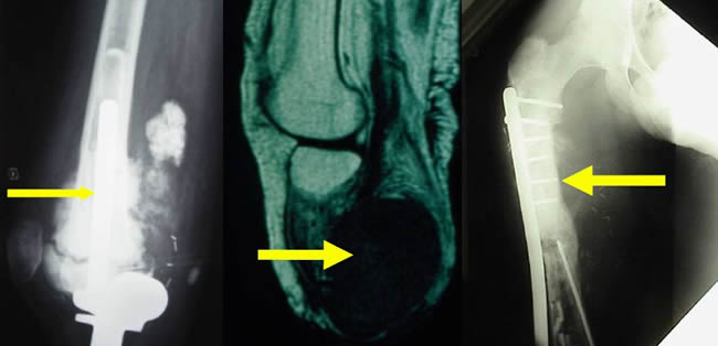 Skip in osteosarcoma