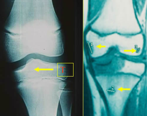 Skip in Ewing's sarcoma