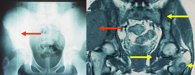 Skip in Ewing's sarcoma