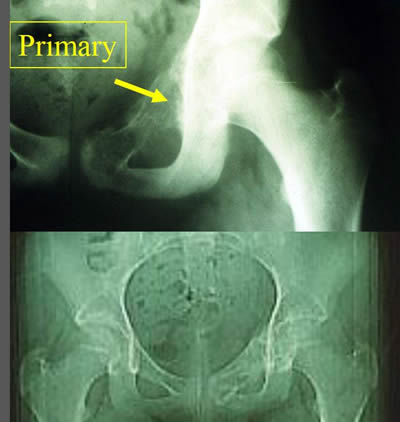 femoral skip metastase of ewing