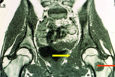 femoral metastase ewing