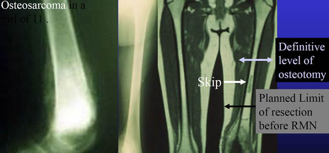 skip lesion distal femur