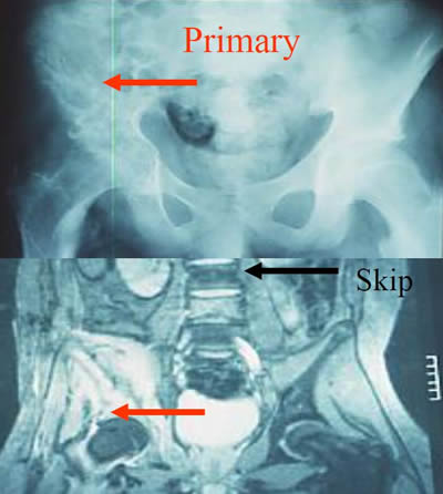 solitary lumbar skip metastase from iliac Ew