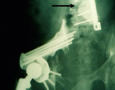 solitary lumbar skip metastase from iliac Ew