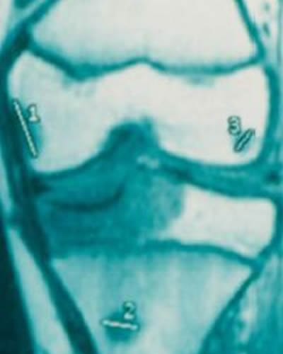 Prognostic value of skip