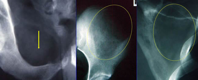 Ostéolyse tumorale