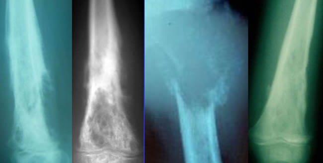 aspect radiologique typique d'Ewing