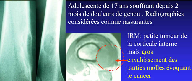 IRM diagnostic précoce