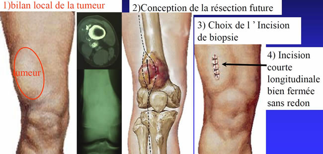 étapes de la biopsie pour tumeur