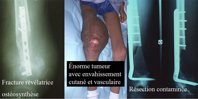 Envahissement cuntané et vasculaire