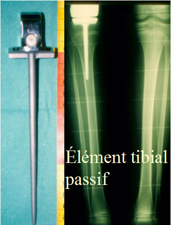 Element tibial