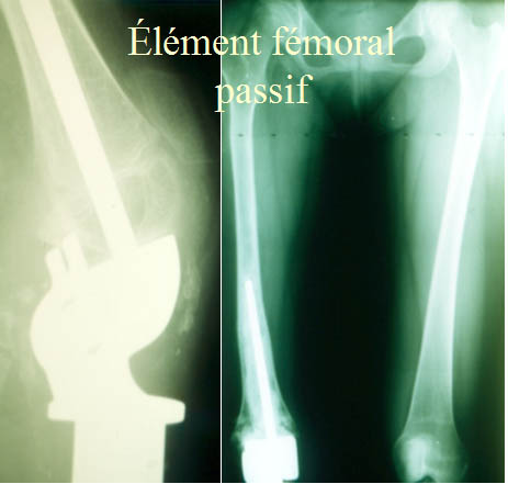 Element femoral