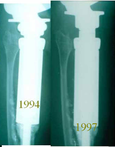 1994-1997 Prothèses
