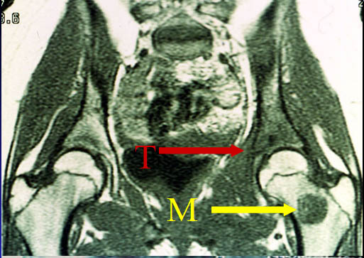 Metastases