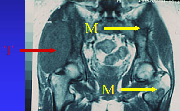 Regional metastases