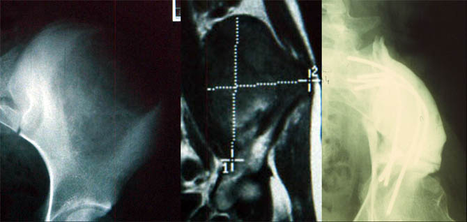 Iliac resection