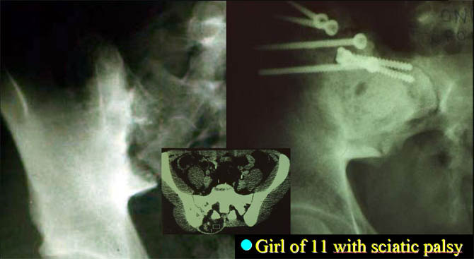 Sacroiliac resection