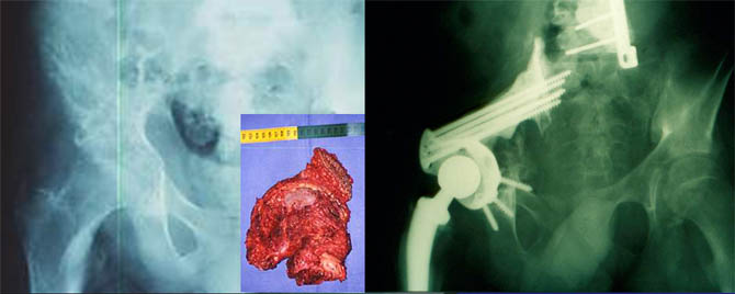 Periacetabular metastase