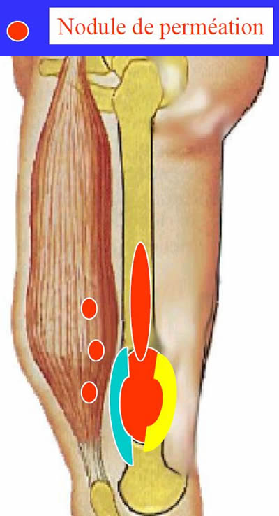 Pseudocapsule Tumorale