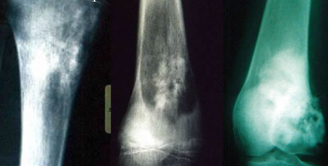 Ostéosarcomes anomalies de la trame osseuse