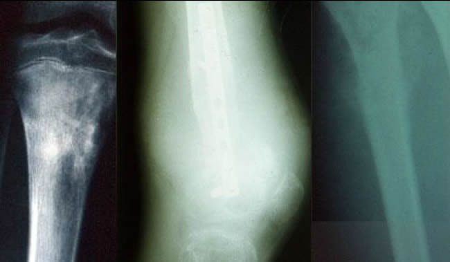 Ostéosarcomes aspects radiologiques