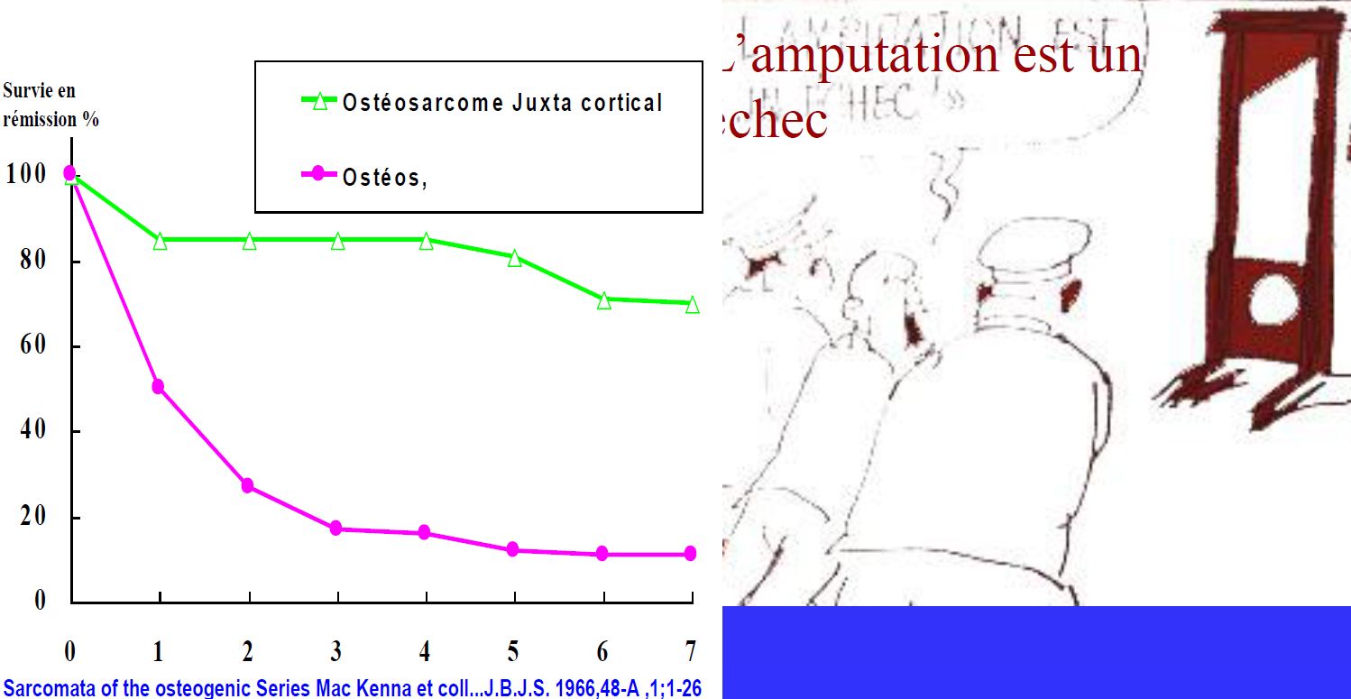 ostéosarcome