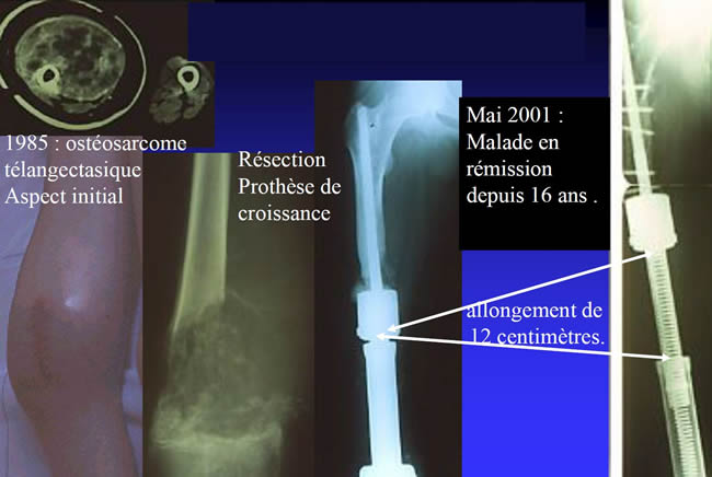 chirurgie conservatrice