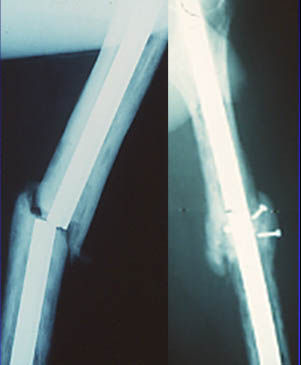 Pseudoarthrose traitée par clou et greffe