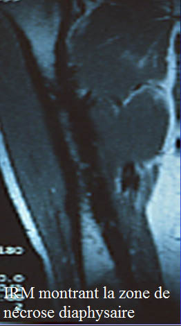 IRM de la zone de nécrose