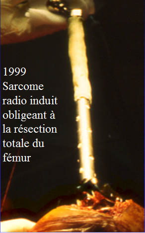 Sarcom radio induit